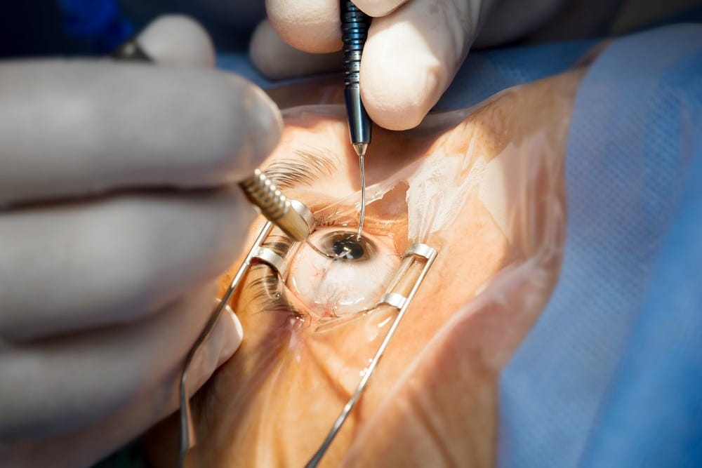 CATARACT SURGERY